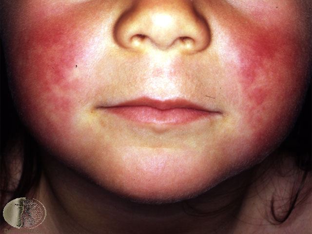 Scarlet Fever : Symptoms , Treatment, and Complications ...