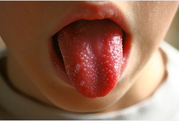 What causes red tongue or strawberry tongue? - WebMD
